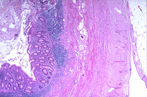 Higher magnification showing lymphoid follicle with germinal centre