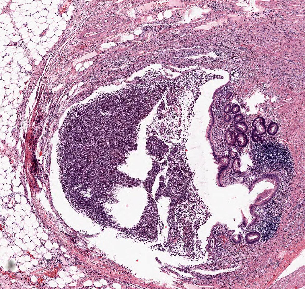 Acute Appendicitis slide 2