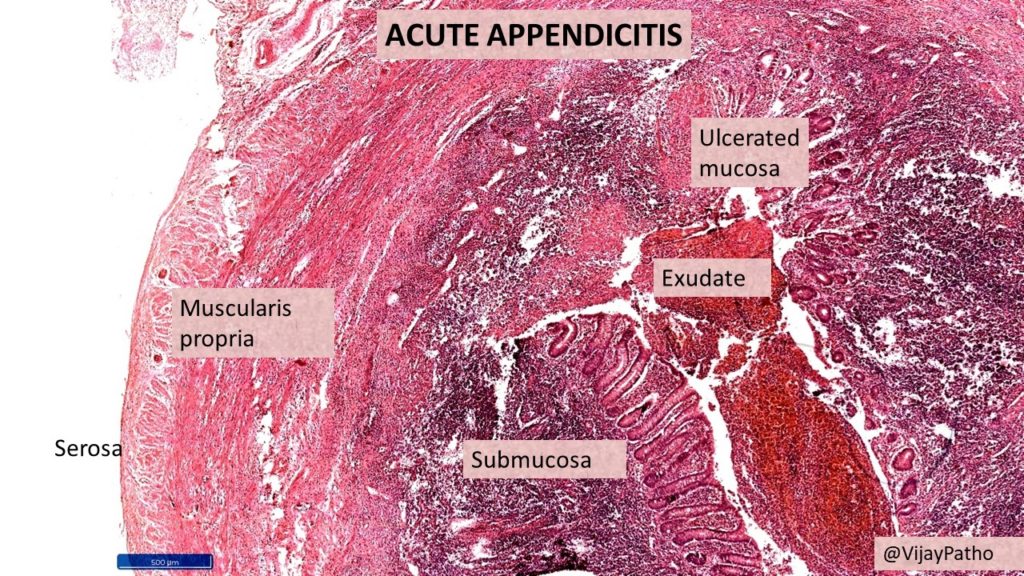 Acute Appendicitis slide 1