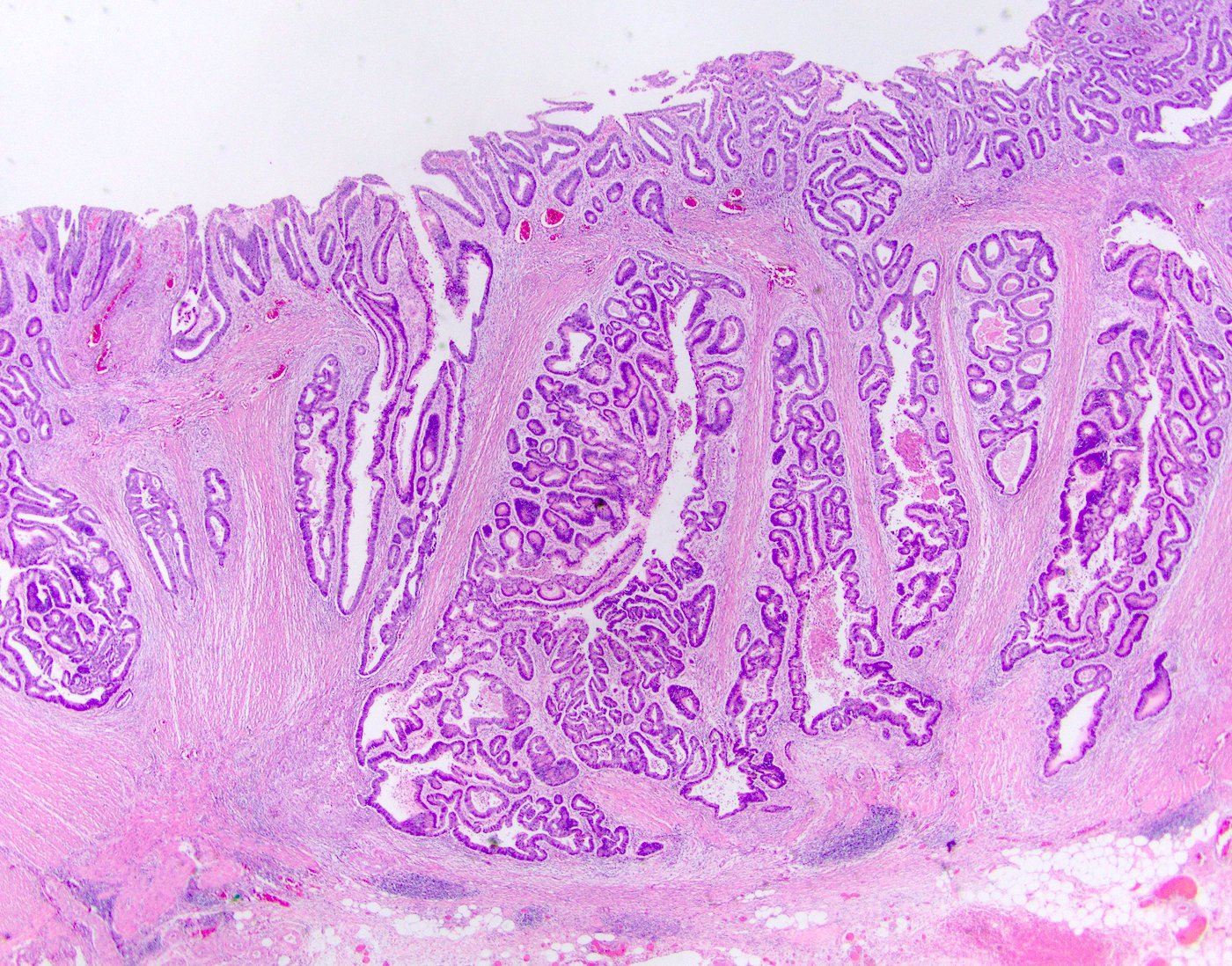 Adenocarcinoma