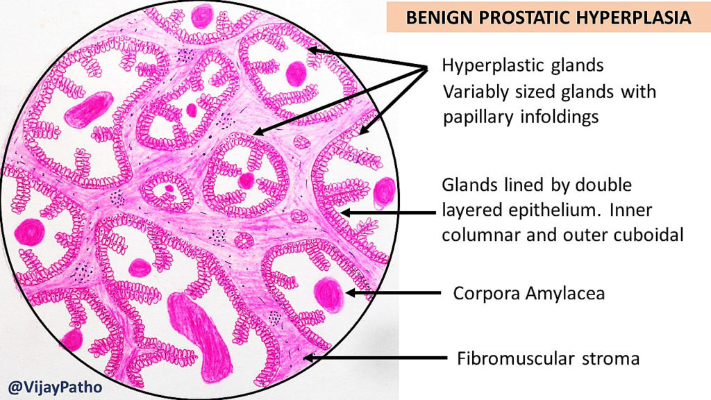 Benign Prostatic Hyperplasia slide 1