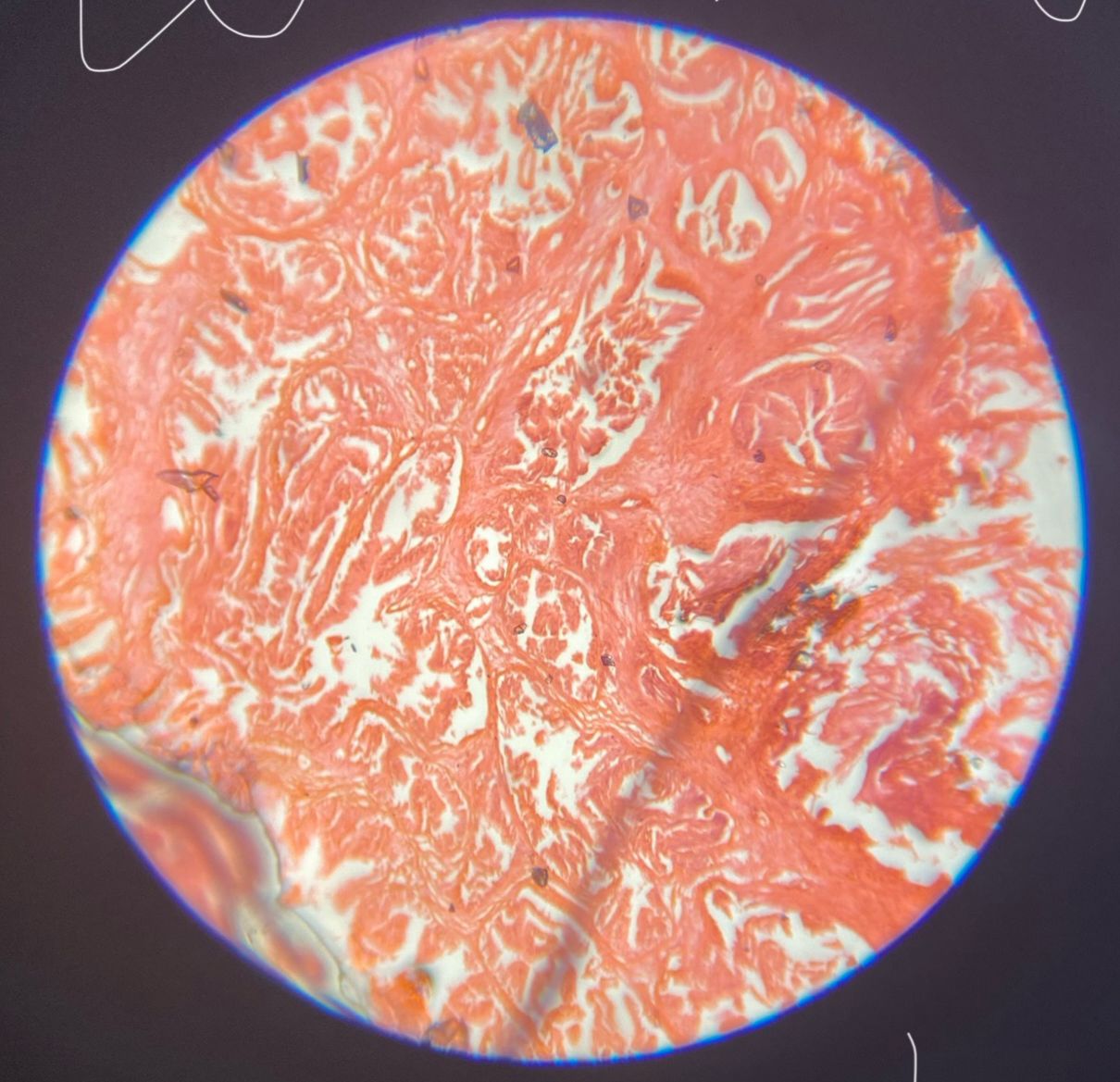 Benign Prostatic Hyperplasia