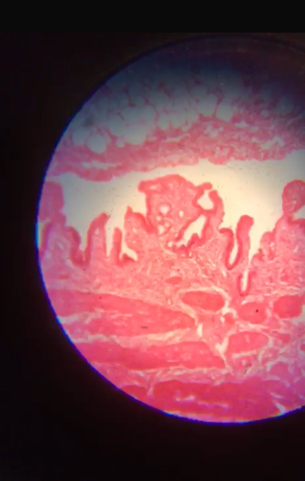 Chronic Cholecystitis