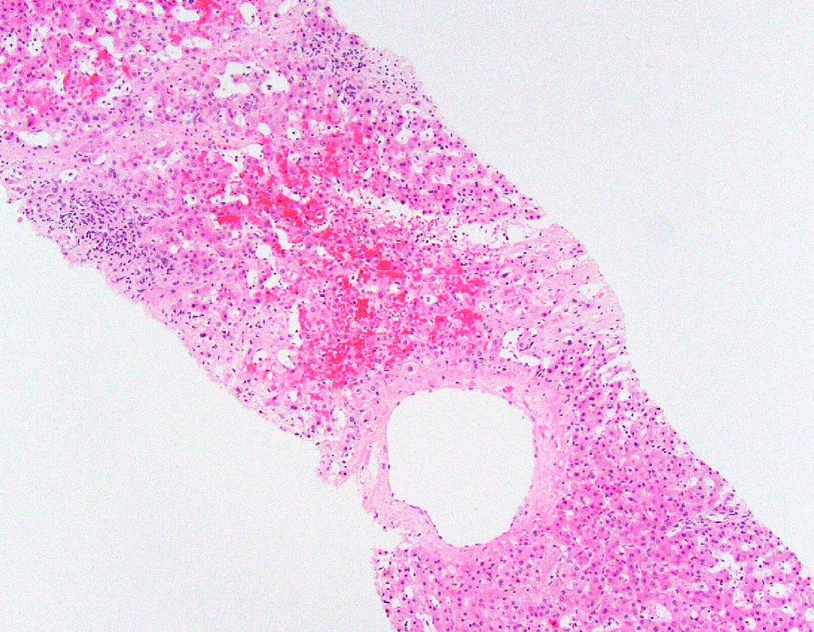 Chronic Venous Congestion (Liver)