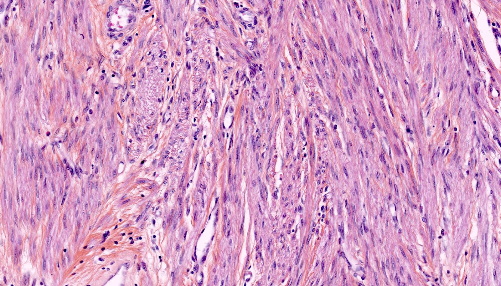 Leiomyoma slide 2