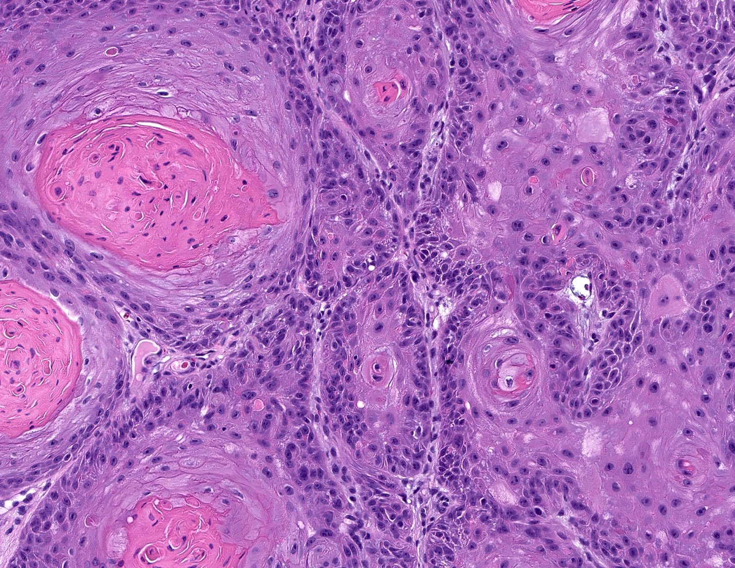 Squamous Cell Carcinoma