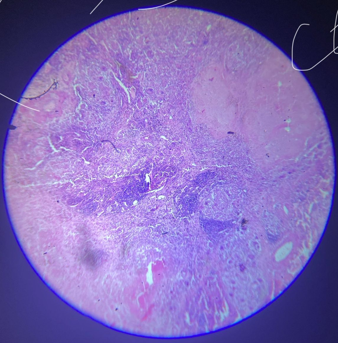 TB Granuloma